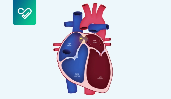 Understanding Atrial Septal Defect: A Comprehensive Guide