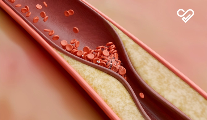 What is Atherosclerosis?