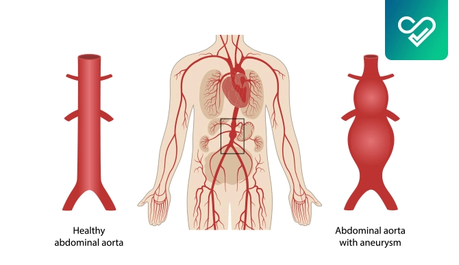 abdominal aortic aneurysm