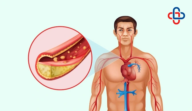 How To Clear Blocked Arteries Without Surgery